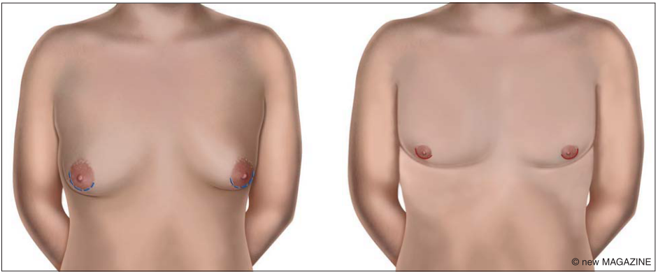 L'intervento per la ginecomastia viene eseguito per correggere deformità o aspetti poco estetici negli uomini