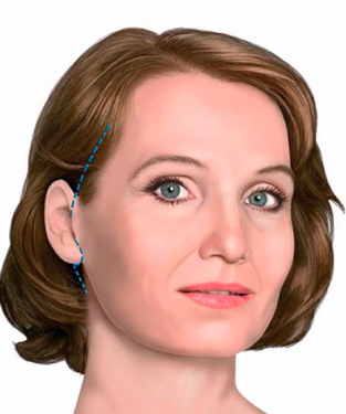 L'intervento di lifting facciale viene eseguito per correggere gli effetti del rilassamento cutaneo