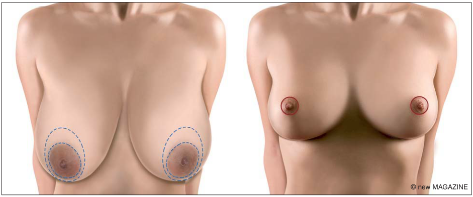 L'intervento viene eseguito per ridurre le dimensioni e correggere la forma delle mammelle